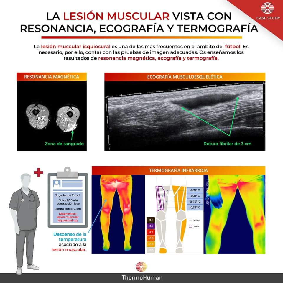 ThermoHuman infographic comparing MRI, ultrasound and infrared thermography in a muscle injury case